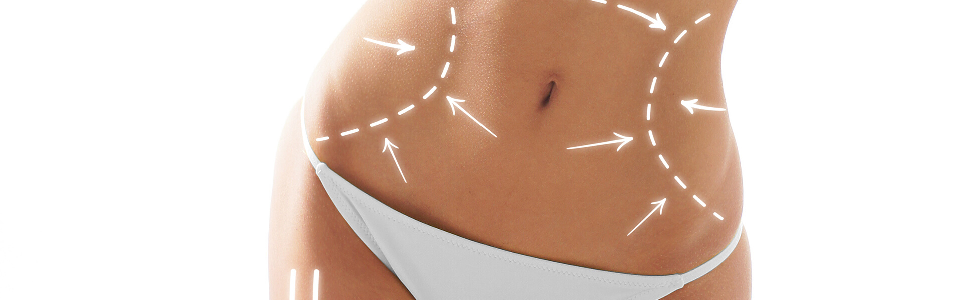 Mini Abdominoplasty Mini Karın Germe