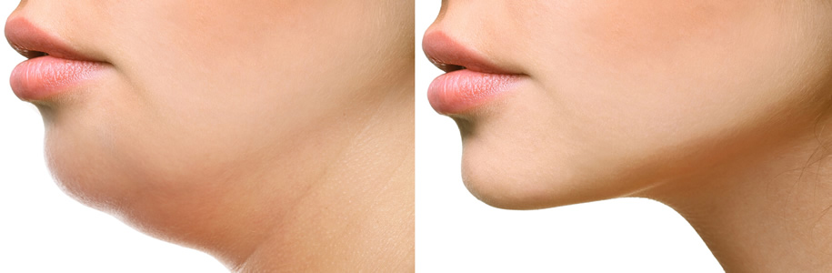 liposuction